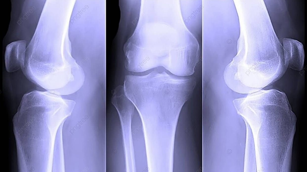Raipur: AI Tool to Detect Bone Weakness From Routine X-Rays Shows 97.7% Accuracy in Early Testing