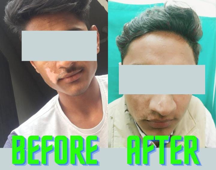 UTG method was used for the first time in Haryana, the patient's face was cured by ultrathin grafting in Agroha Medical