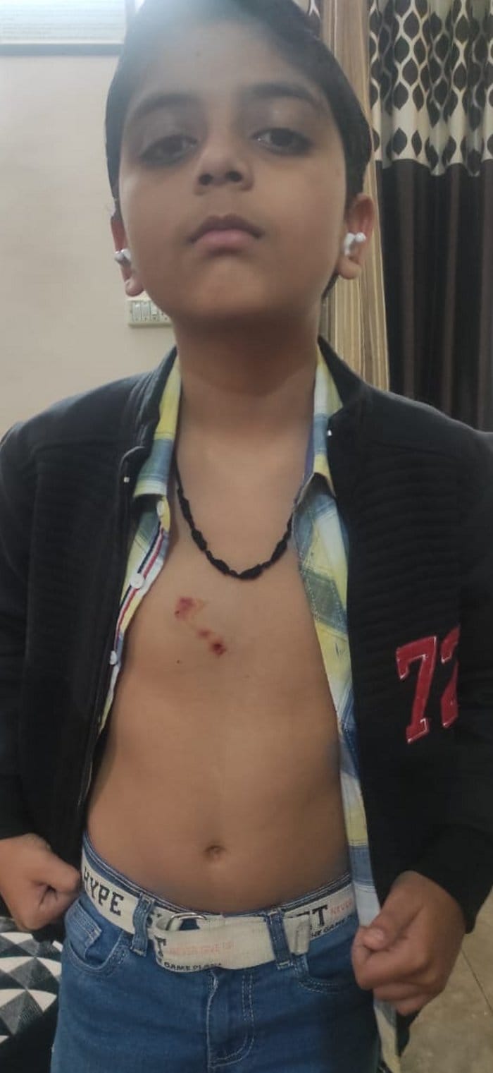 Pitbull dog attacks child