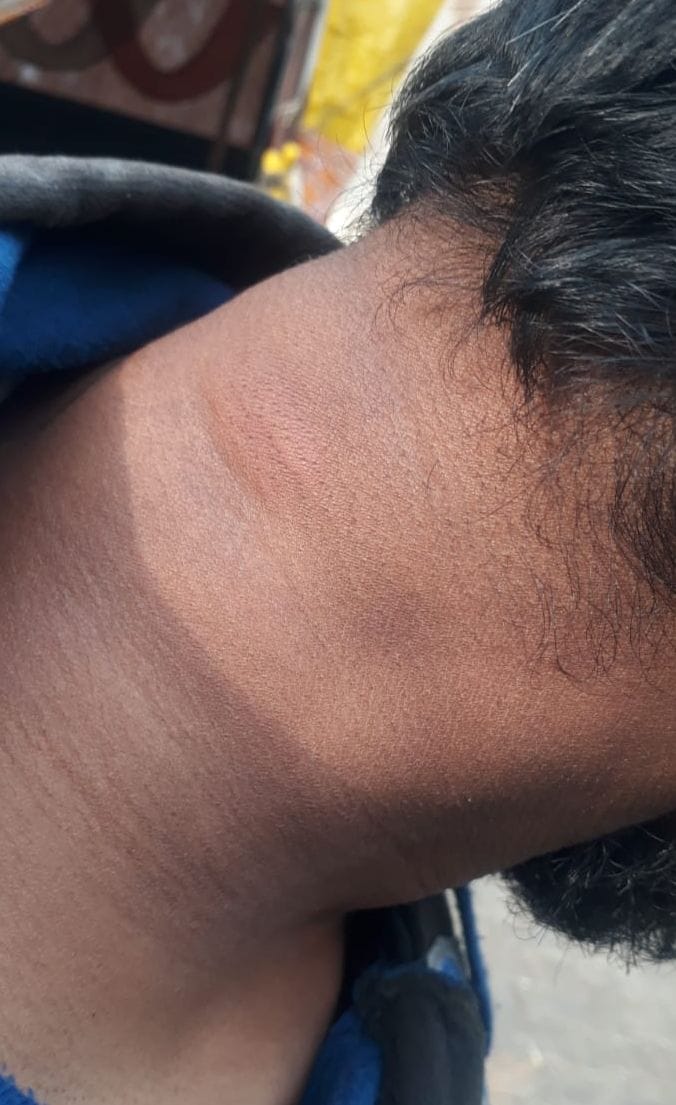 Bees attacked the dharna of Divyangs outside the mini secretariat, the condition of 6 worsened