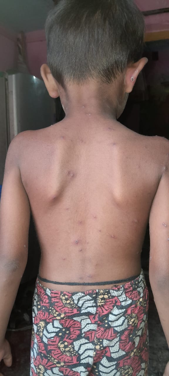 One person died due to chicken pox, many sick