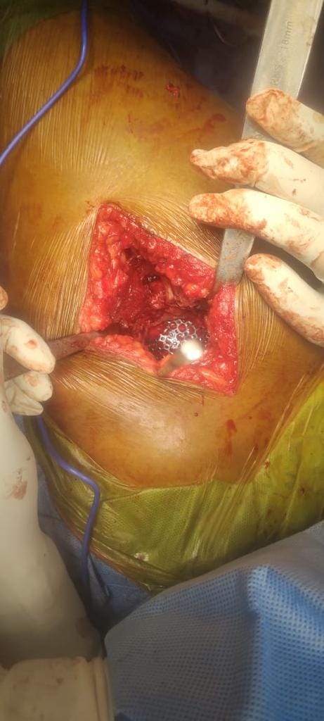 Hip made of titanium mesh after research, gave life to a woman