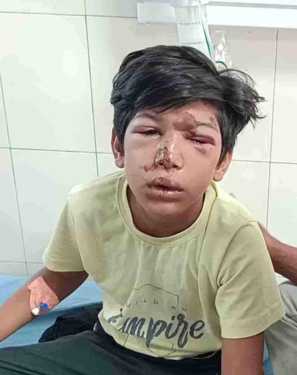 Cow hit two scooty riding brothers, one had broken nose, eye injury