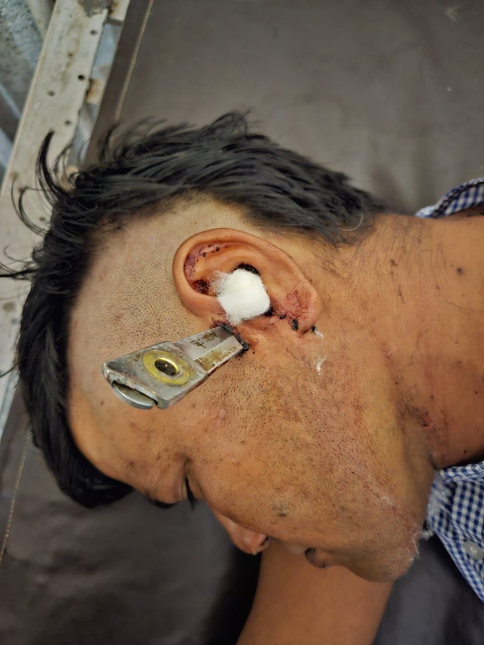Kanpur Dehat : The knife entered the temple of the young man, reached the brain, the doctors of Halat operated