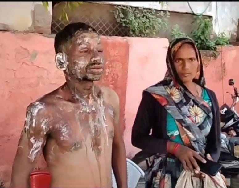 Set fire by pouring diesel and petrol, got burnt