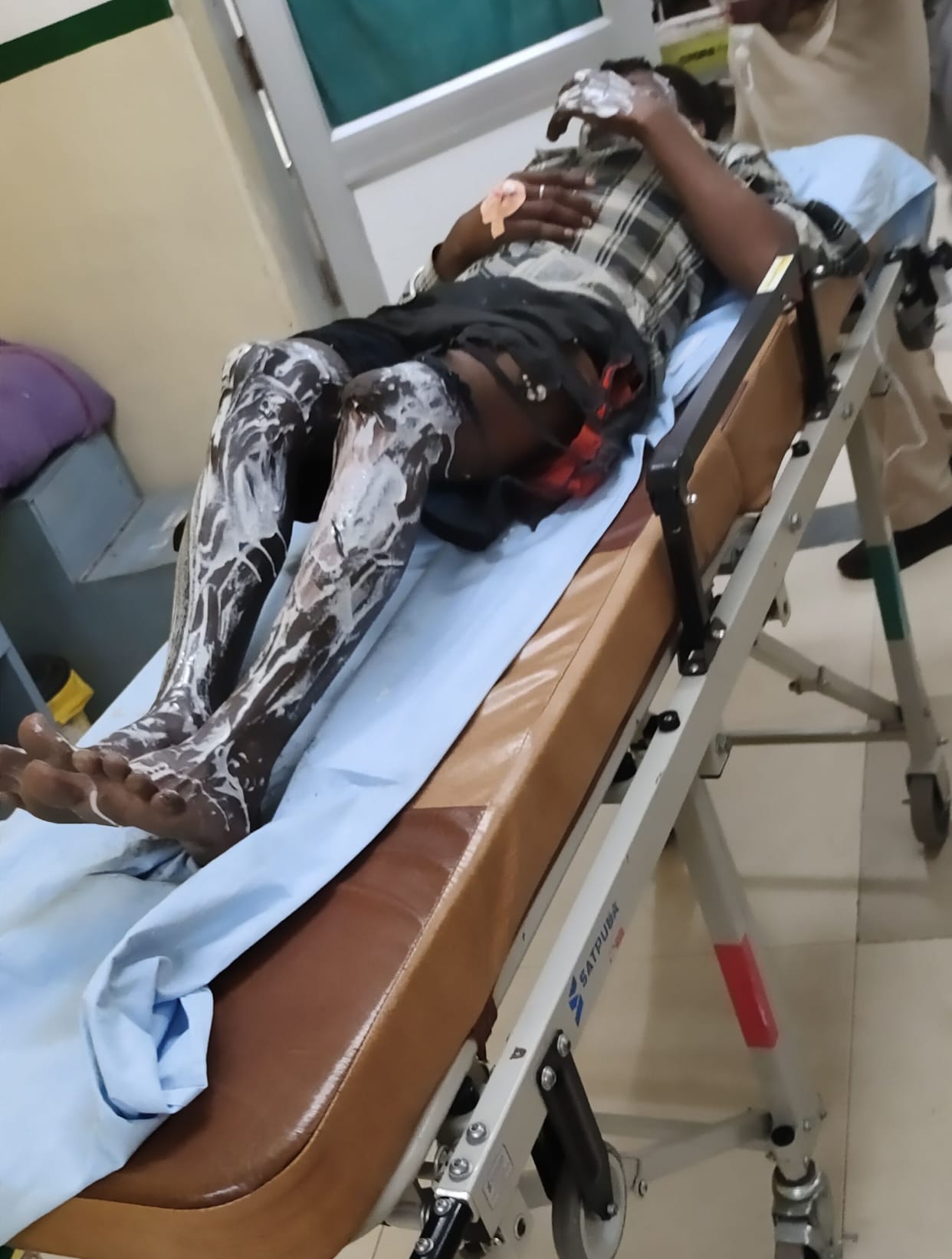 Due to fireworks on Diwali, 17 people got burnt at different places, fire broke out at six places, fire brigade ran away