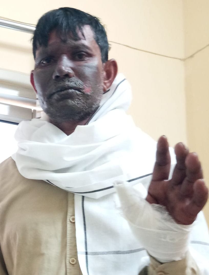 MLA angry over burnt laborer not getting treatment