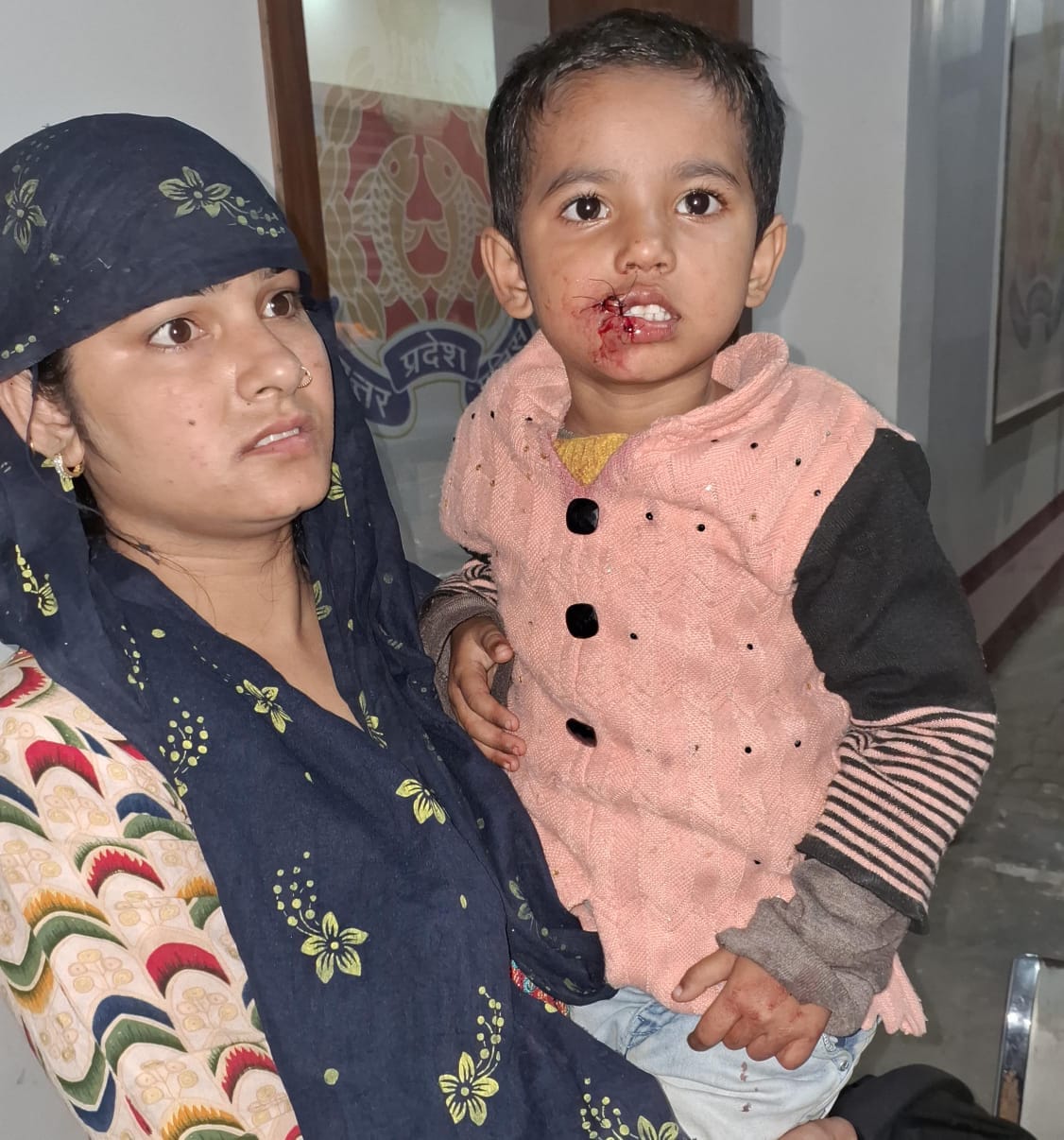Dog attacked girl on her birthday, got four stitches on her face