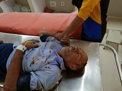 Rebar collided with high tension line, two workers burnt