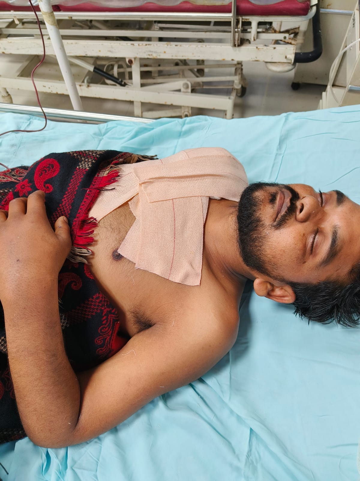 Electric mechanic lost his hand after being hit by high tension line
