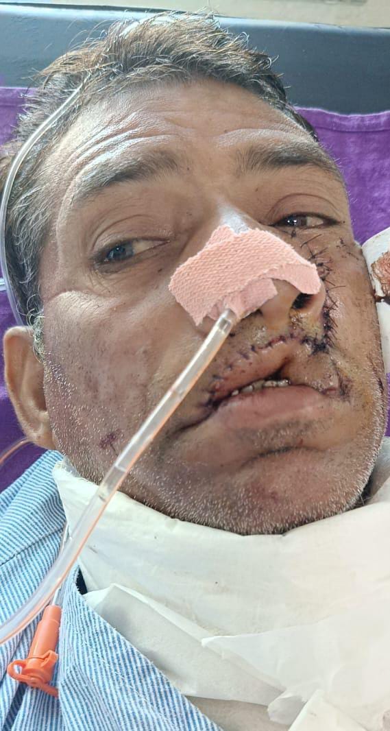 Cancer spread to jaw due to tobacco and beedi, removed in seven hoursSend feedback