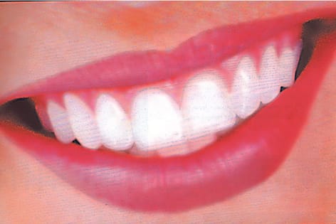 Gingivitis disease is increasing in teeth due to change in hormones.