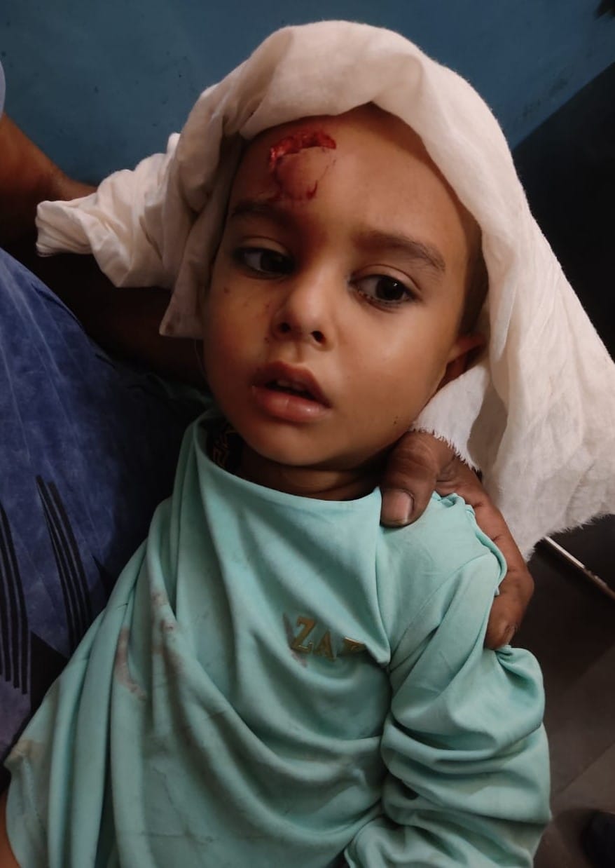 Monkey attacks innocent child playing on terrace, serious