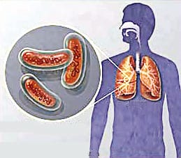 CHO will take training in detecting TB disease