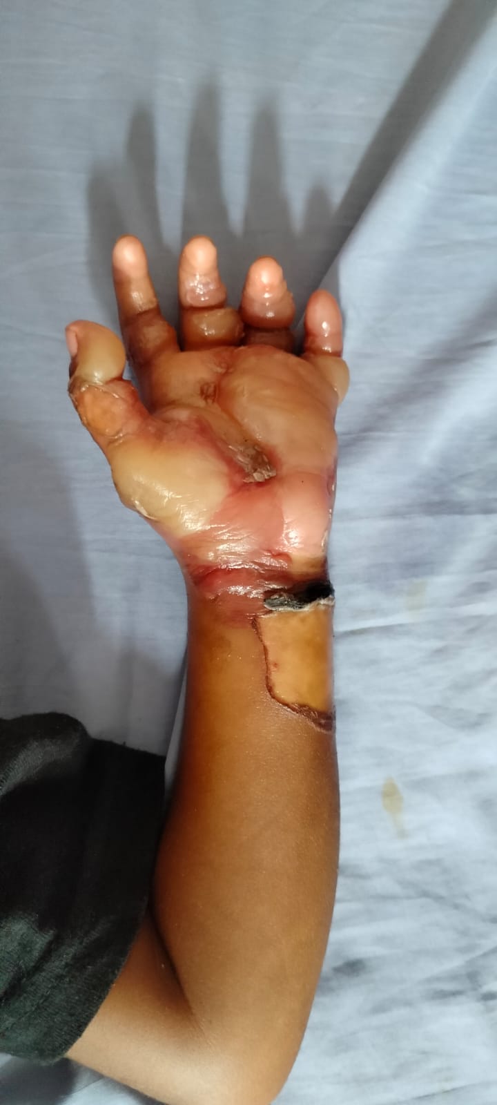 Superstition: Both hands were burnt, the innocent was thrown on the bed saying that he was the shadow of three devils