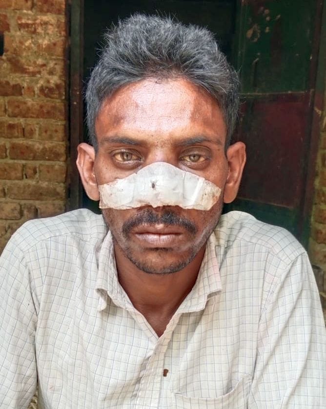 Laborer's nose bitten, 16 thousand rupees snatched away