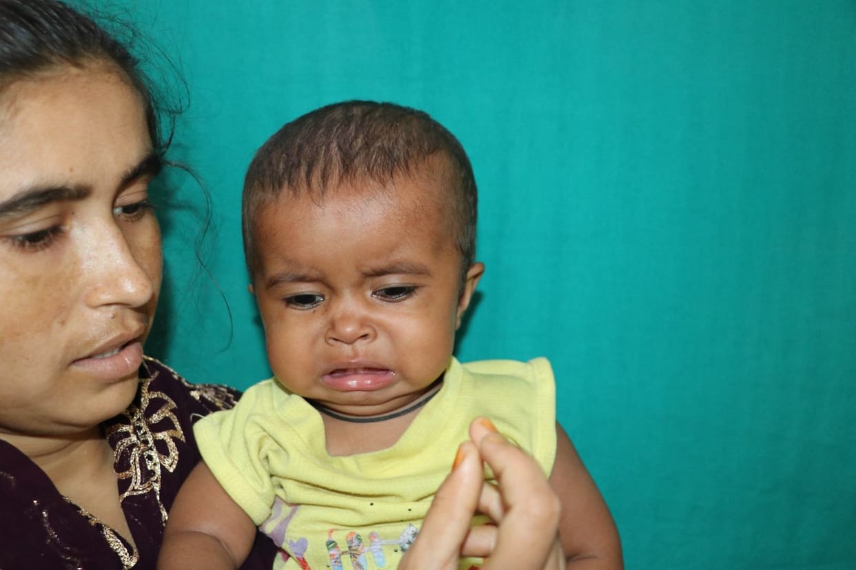 Successful operation of palate of one and a half year old girl