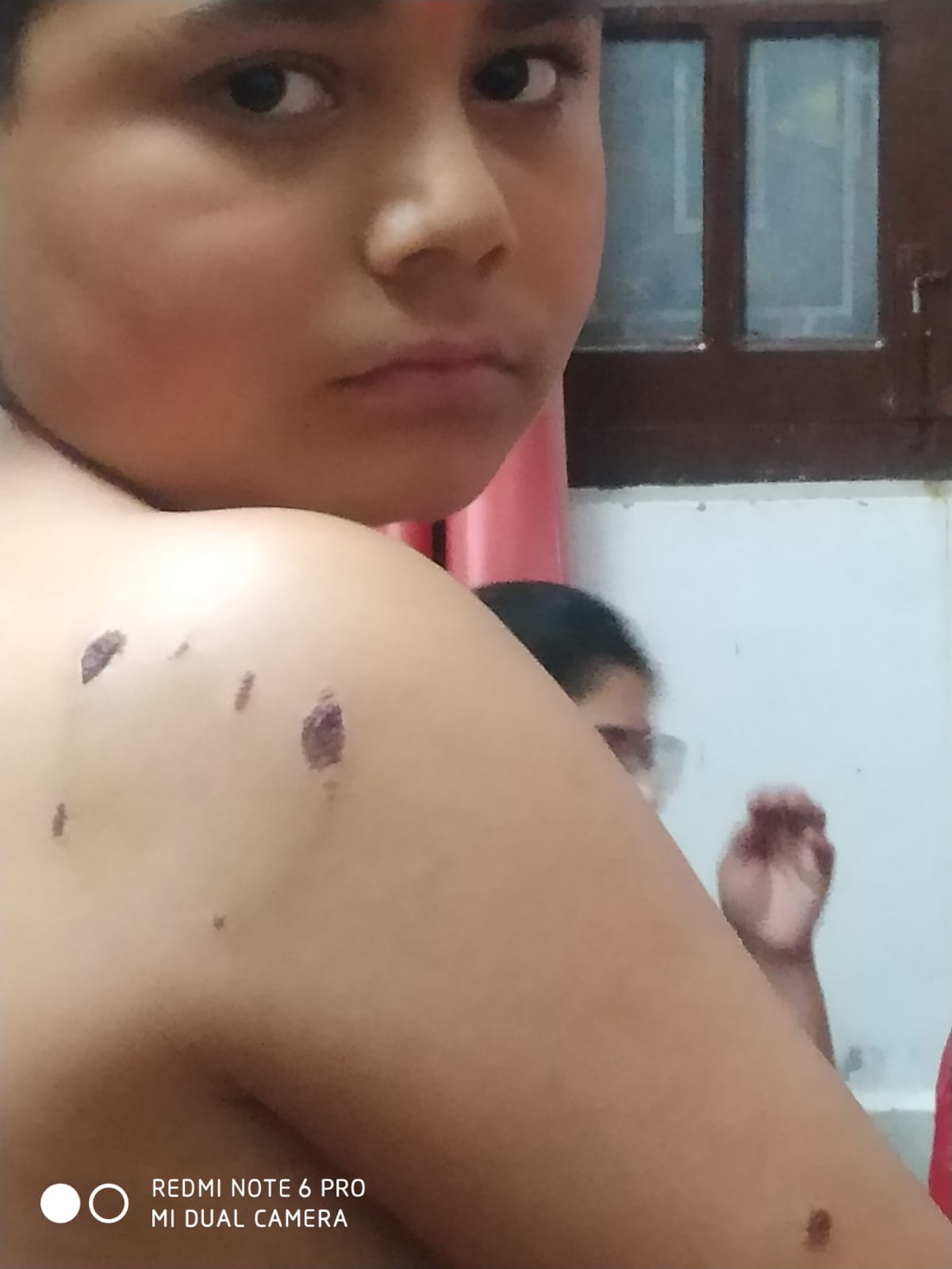 Pet dog bit three children in Lahaldi village