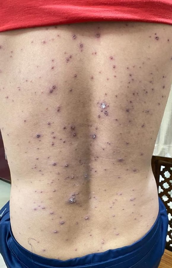 Five patients of chicken pox are being found every day, leave the misconceptions and get treatment from a doctor