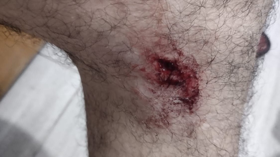 Now a person who went for morning walk in Dalhousie is attacked by stray dogs