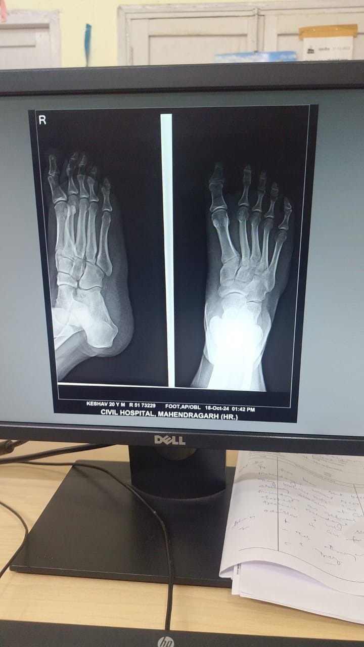 Film of X-ray machine not available in Mahendragarh Civil Hospital for 5 months