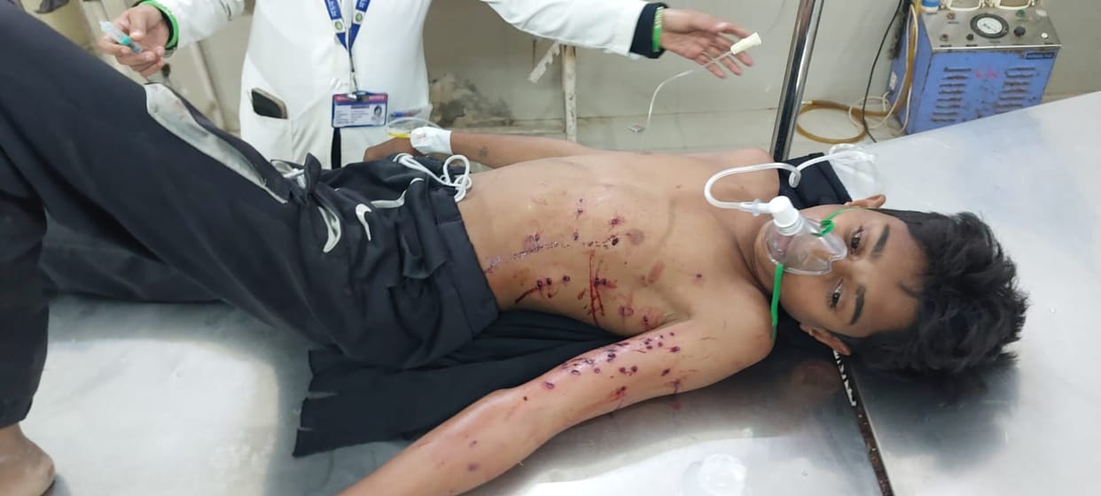Damoh A minor going to field found a pistol on way and as soon as he fired, he got hit by pellets in his body