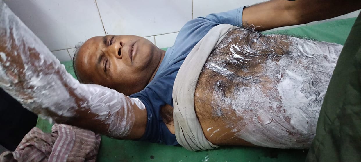 Mill worker severely burnt while on duty