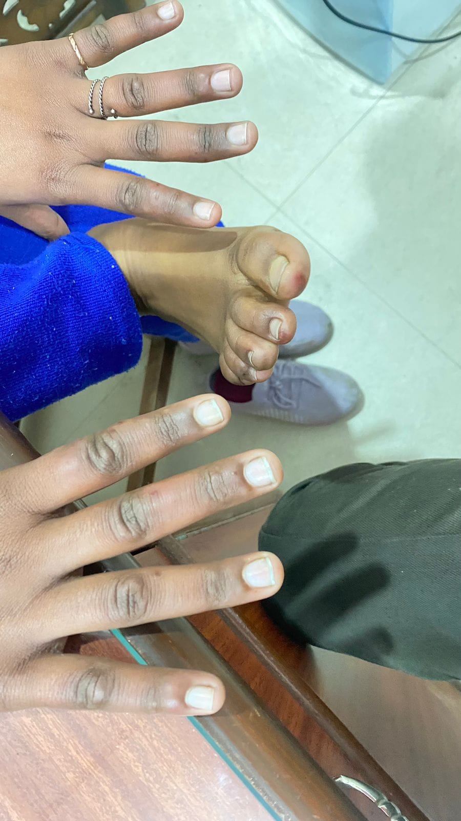Chilblains attack in severe cold, itching and swelling in the skin are signs
