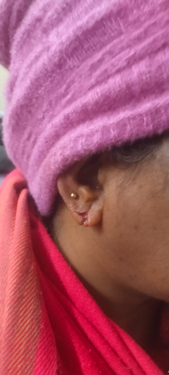 Snatcher absconds after snatching earring, woman's ear cut, seven stitches required