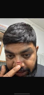 Chinese manjha lekhpal's nose is becoming deadly