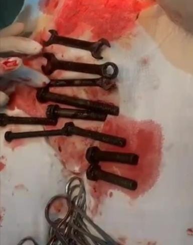 A young man swallowed seven nuts, bolts and three wrenches, his life was saved by surgery