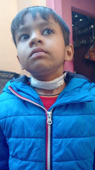 Child coming from tuition got hit by Chinese string, got two stitches in neck