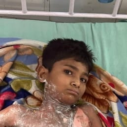 A teenager who got burnt due to electric current in a Chinese manjha died
