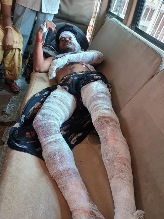While stitching bangles, kerosene can burst, couple got burnt