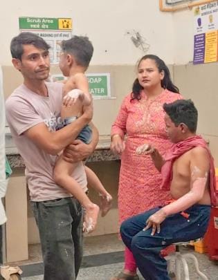 Two children burnt in a house fire, admitted to burn ward