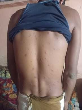 Chickenpox outbreak in rural areas