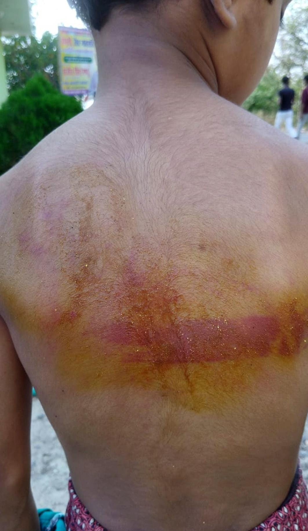 Class-4 student beaten by iron scale by teacher