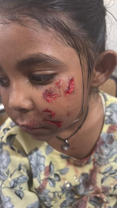 Stray dogs mauled a girl returning home from tuition