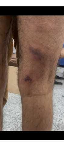 Student Injured in Ragging Incident at Pacific Medical College