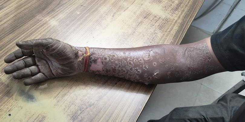 Spark came out from the panel of railway electrical sub-station, railway worker got burnt