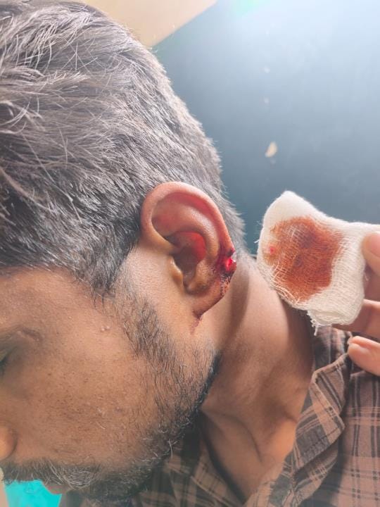 Pickpockets active during blackout, two injured, 13 thousand rupees and mobile snatched