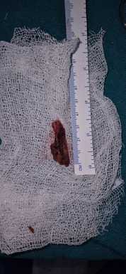 3.5 cm piece of wood removed from the eye of a 10 year old child