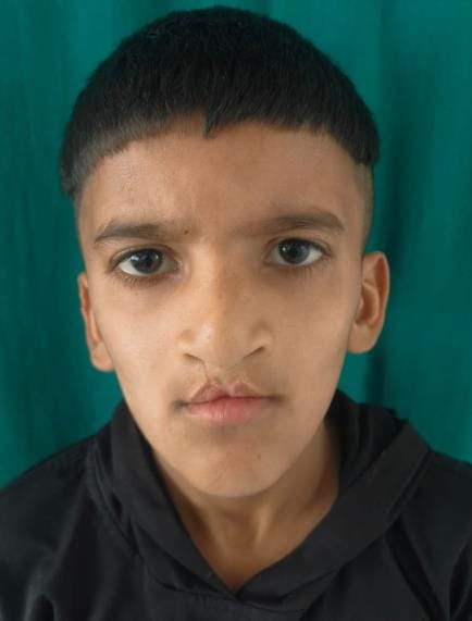 Free operation of student's cleft lip