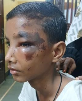 Flammable substance poured on the face of a child sleeping on the roof