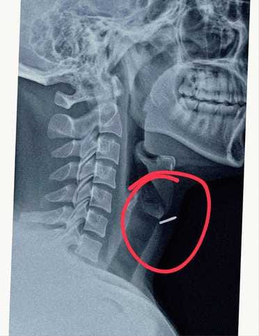 Doctors performed surgery to remove nail stuck in the carpenter's neck