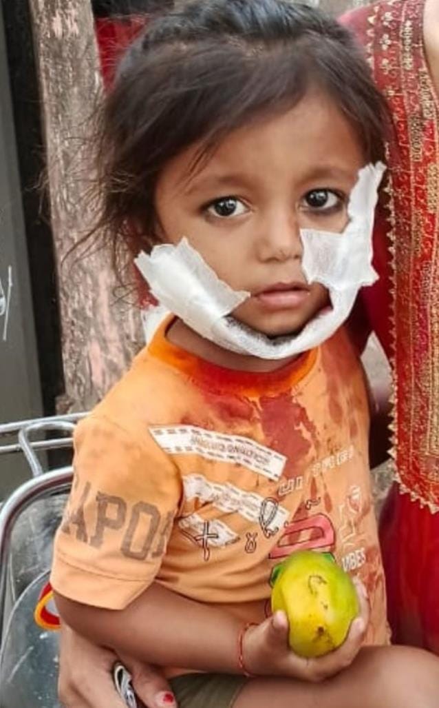 One and half year old innocent child bitten by dog, serious