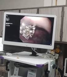 पेट से एंडोस्कोपी द्वारा निकाली गई बच्ची की निगली हुई पायल