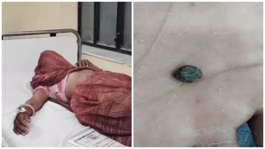 पथरी के इलाज के नाम पर महिला से धोखा।