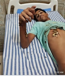 A teenager got burnt after coming in contact with a high tension line