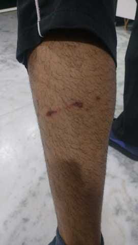 A student was bitten by a dog in Kalandi Kunj, people created a ruckus